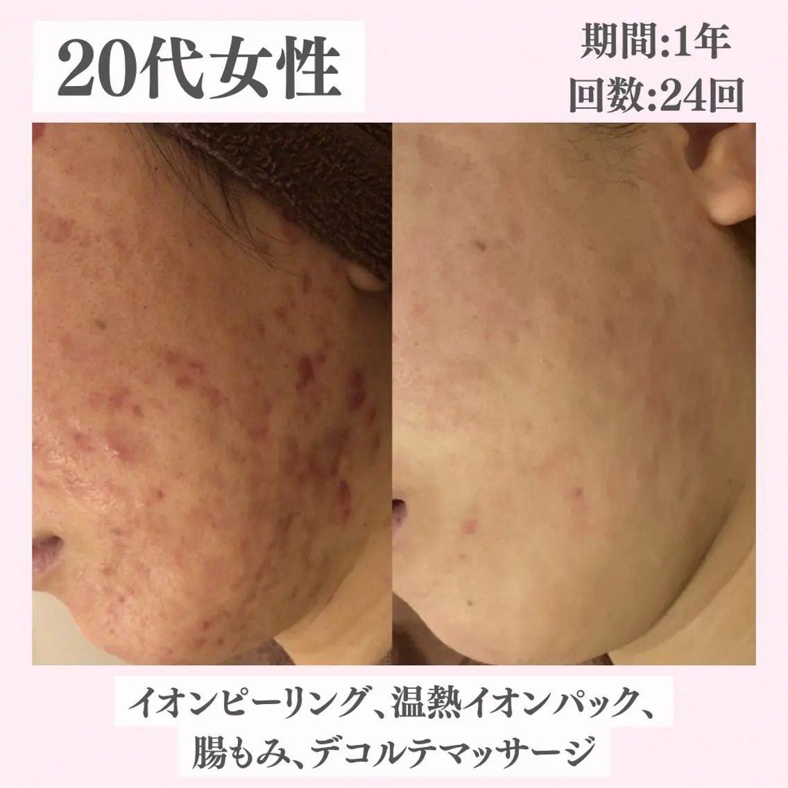 エステ リラク ニキビ・肌質改善専門 ♡人生が変わるサロンのエステ・リラクイメージ
