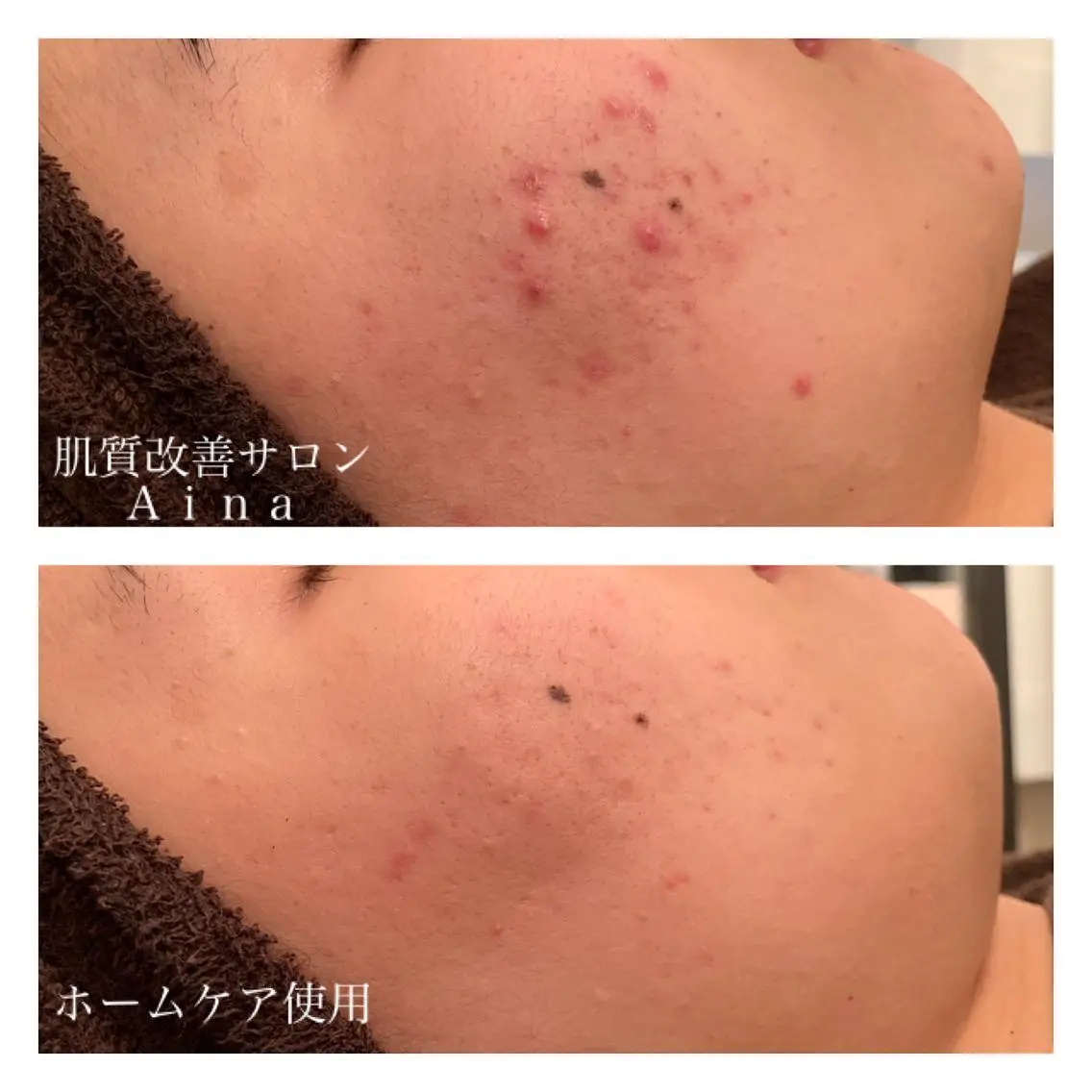 ミディアム カラー パーマ ヘアアレンジ メンズ キッズ ネイル マツエク・マツパ トリートメント 赤色 エステ リラク ニキビ跡専門サロン Ainaのエステ・リラクイメージ