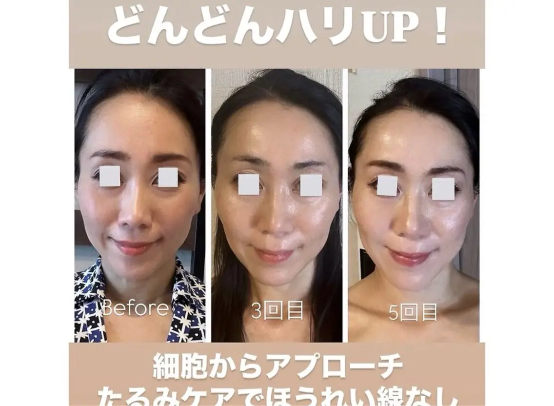 🩵人気No3🩵首までしっかり施術✨水光ツヤ肌✨プラズマ×リジュラン導入&パックの写真
