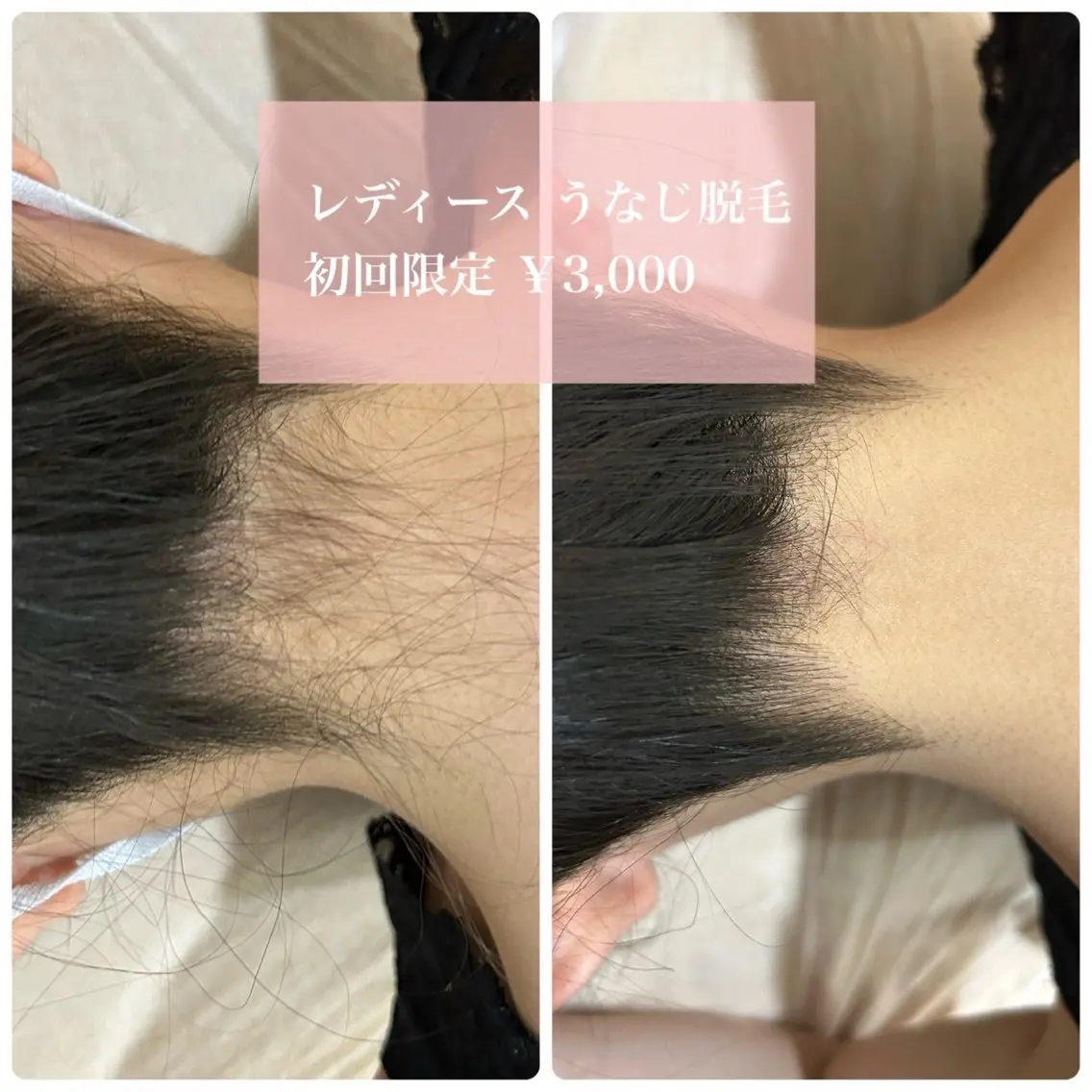 ［女性］🤍うなじ脱毛の写真
