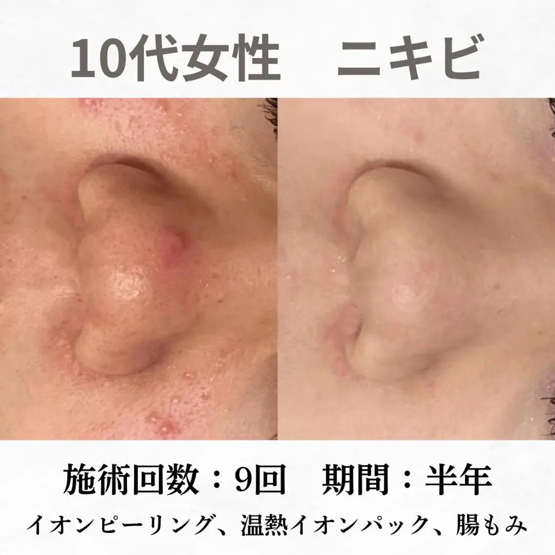 重度ニキビ専門🌷 ダウンタイムなしのエステ・リラクイメージ