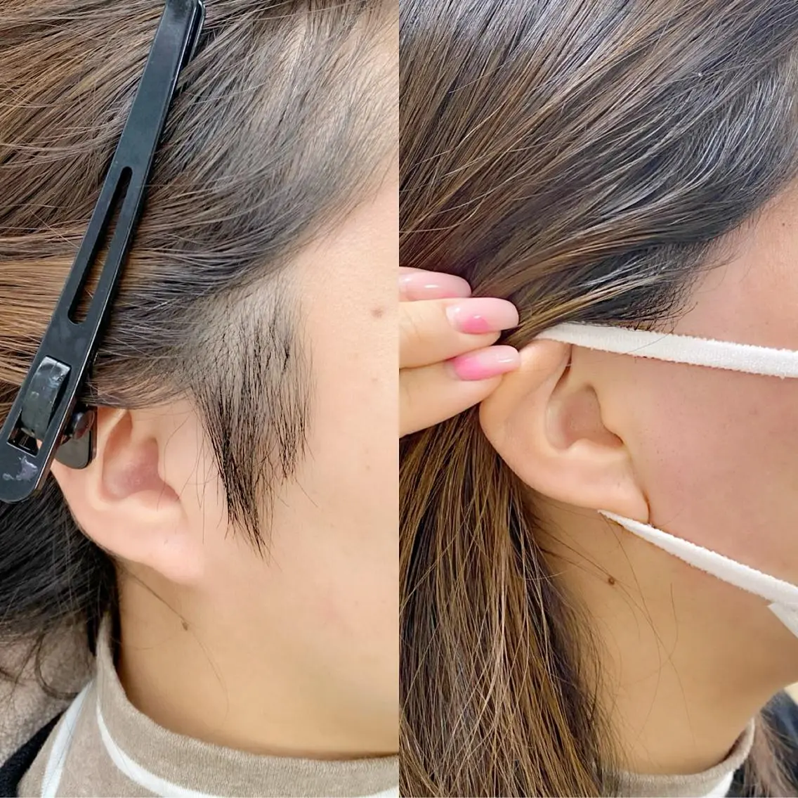 スッキリ垢抜け🤩うなじ&もみあげワックス脱毛 ¥5000の写真