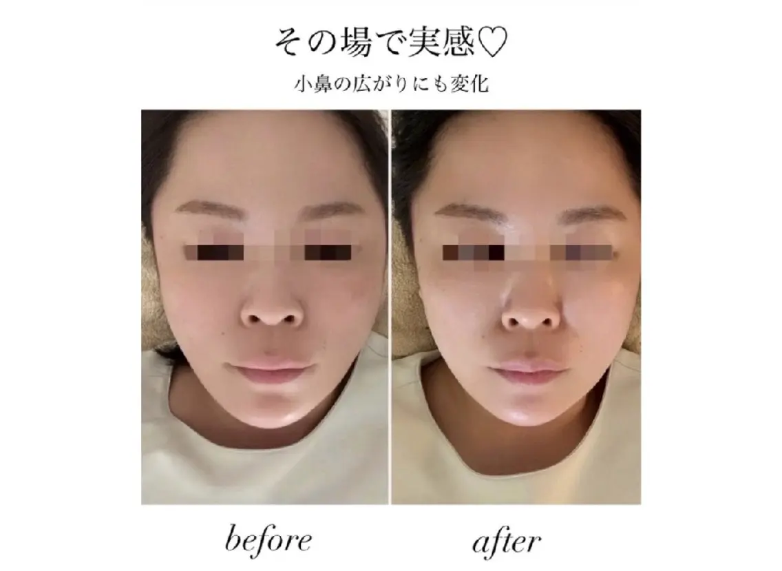 【小顔集中】顔インナー◎1ヶ月通い放題24,800の写真