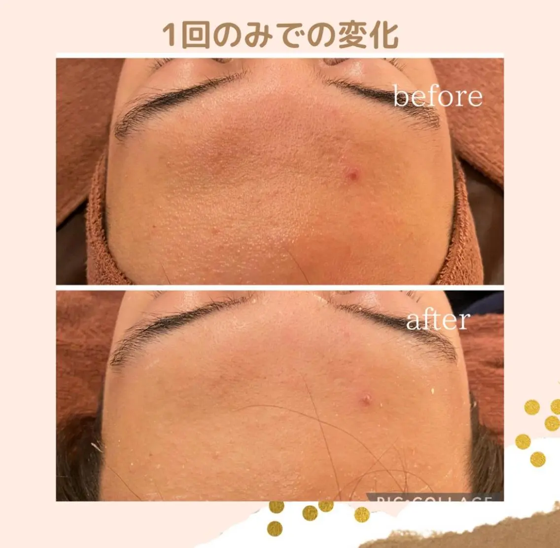 3か月で肌革命👼 ニキビ専門店💫のエステ・リラクイメージ