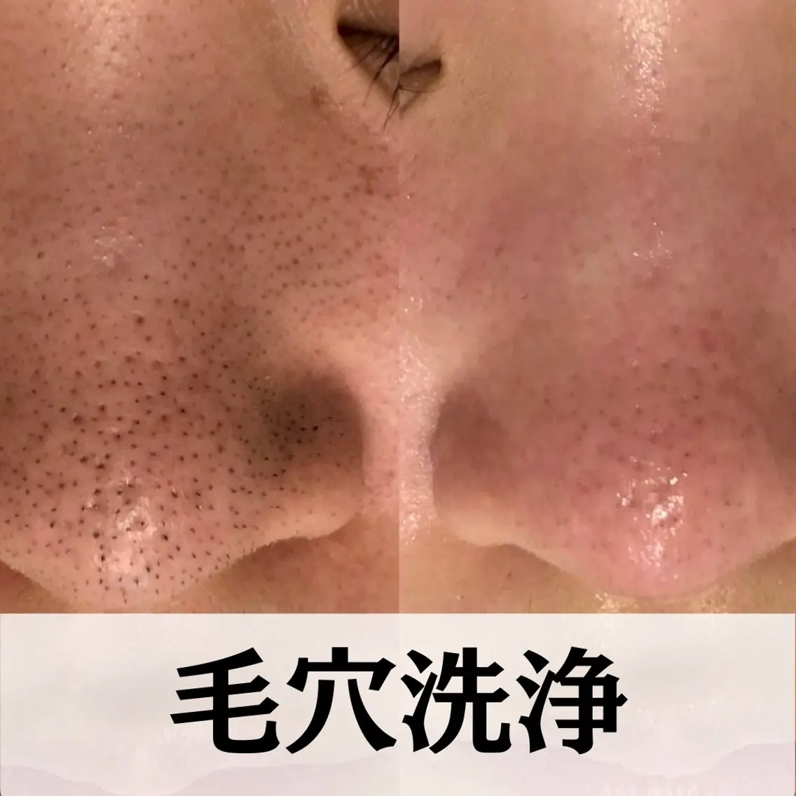 【男女/新規/花粉や皮脂対策で透明肌へ!】全顔3D毛穴洗浄 初回体験¥5500の写真