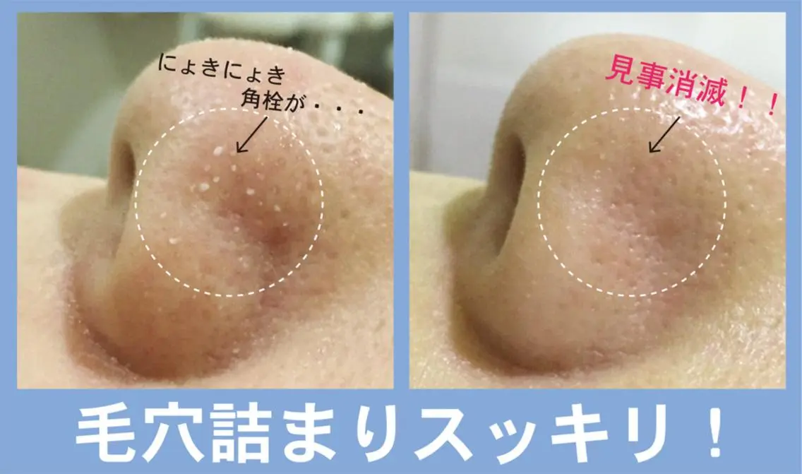 【ミニモ限定】⭐︎毛穴洗浄フェイシャル≪人気No1≫黒ずみ・ざらつき改善の写真