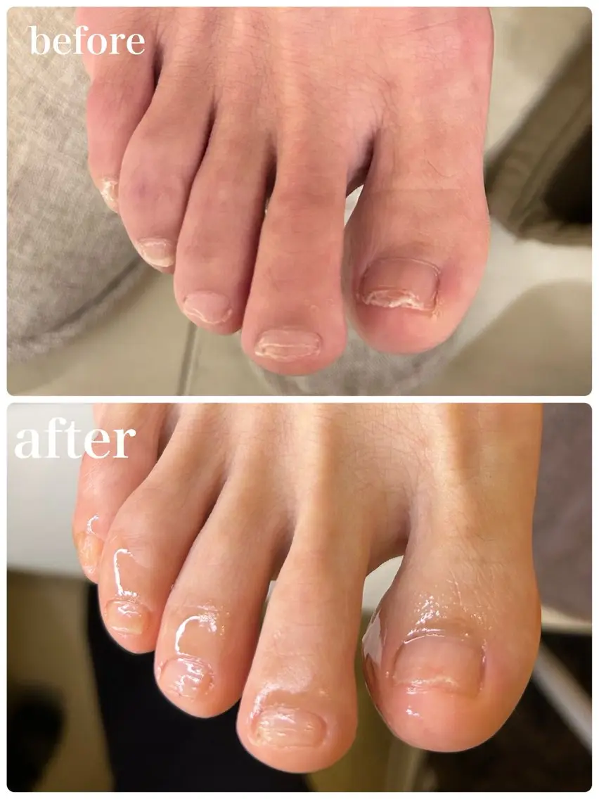 フットケア　フットバス＋両足の爪切り＋爪の表面整え＋保湿込み✨の写真