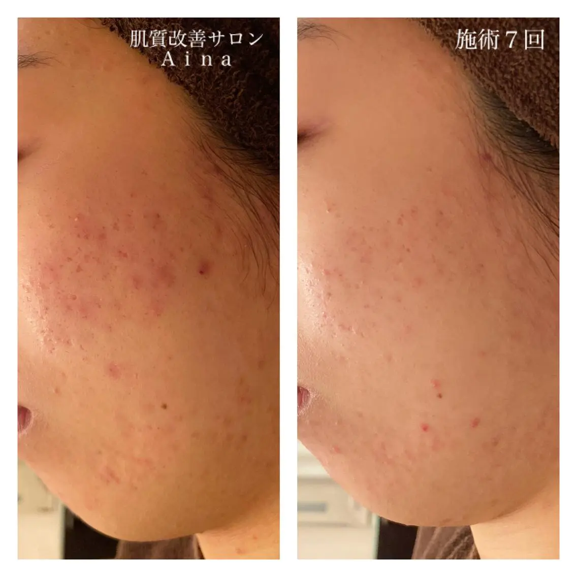 ロング カラー パーマ ヘアアレンジ メンズ キッズ ネイル マツエク・マツパ 赤色 エステ リラク ニキビ跡専門サロン Ａｉｎａのエステ・リラクイメージ