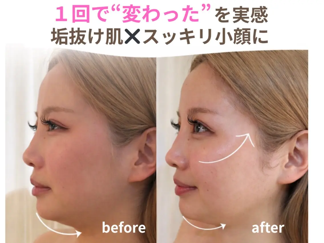 小顔矯正のみ🪄お試し3回目までこちらの価格OK💫　痛みの少ない小顔矯正💫の写真