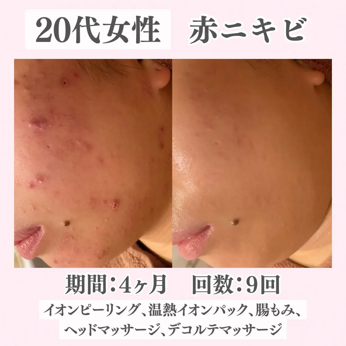 エステ リラク ニキビ・肌質改善専門 ♡人生が変わるサロンのエステ・リラクイメージ