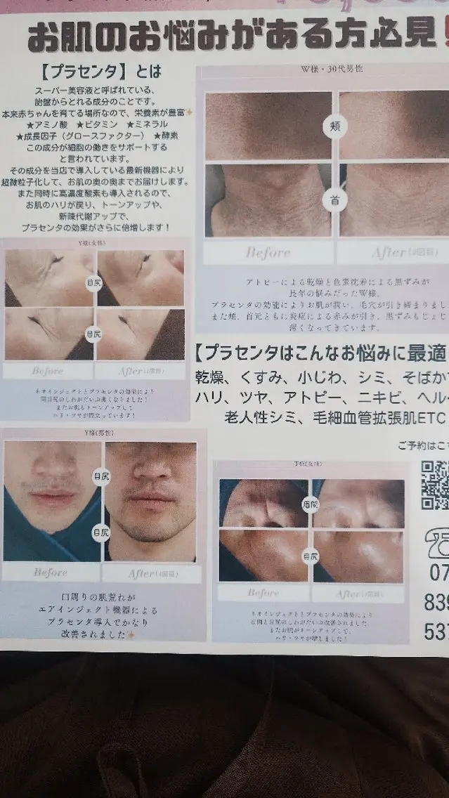 【メンズもOK】プラセンタフェイシャル（高速エアジェット）30分の写真