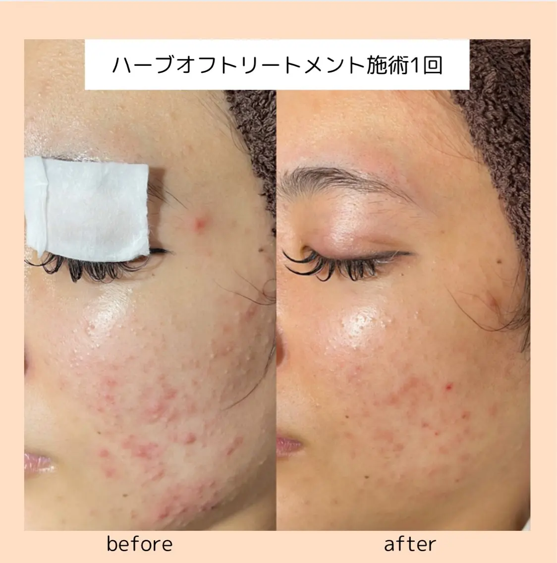 《剥けない》国産100%ハーブ使用🌿‬贅沢トリートメントの写真