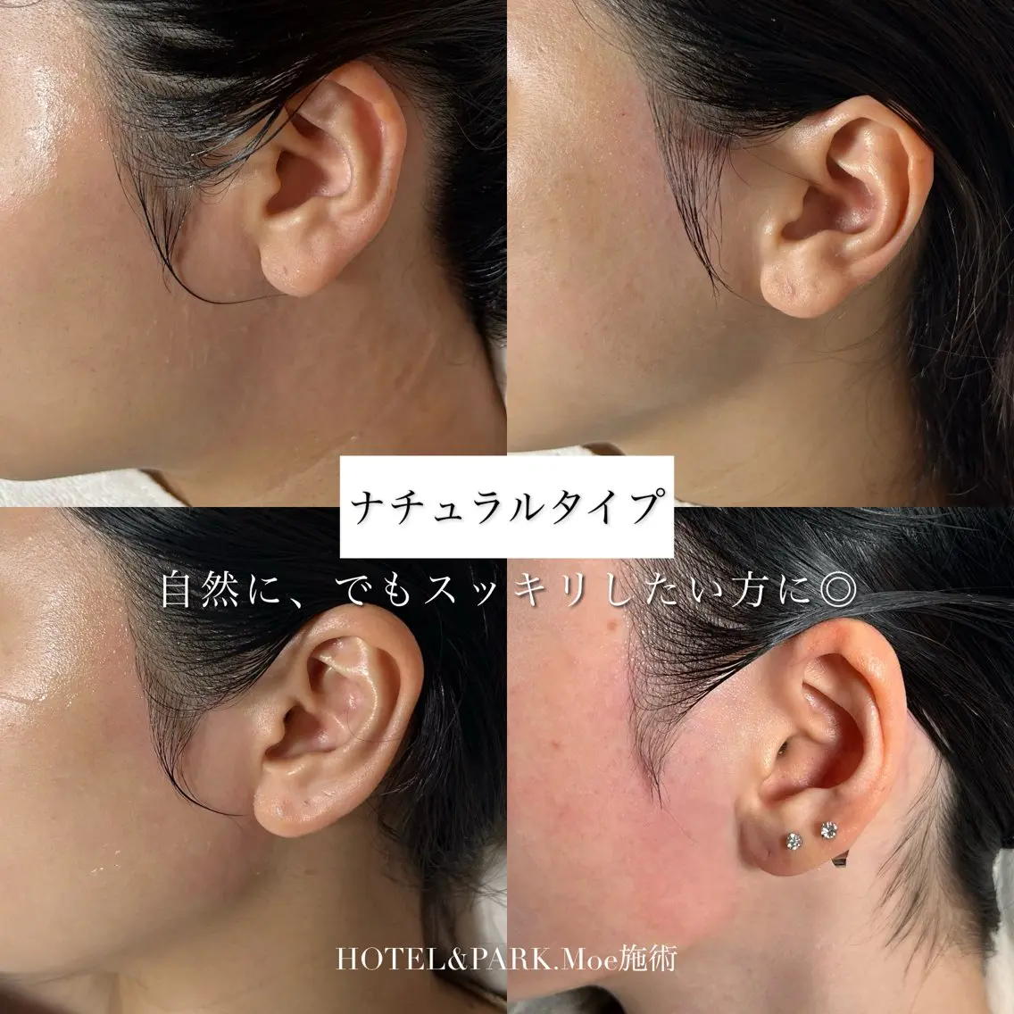 脱毛 HOTEL&PARK .Moeワックス脱毛のエステ・リラクイメージ