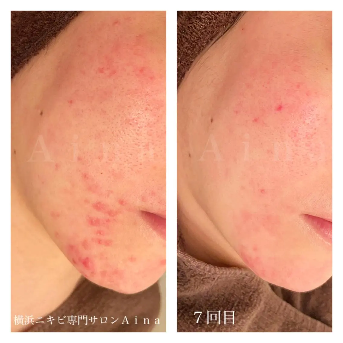 ミディアム カラー パーマ ヘアアレンジ メンズ キッズ ネイル マツエク・マツパ クリアネイル 赤色 エステ リラク ニキビ跡専門サロン Ainaのエステ・リラクイメージ