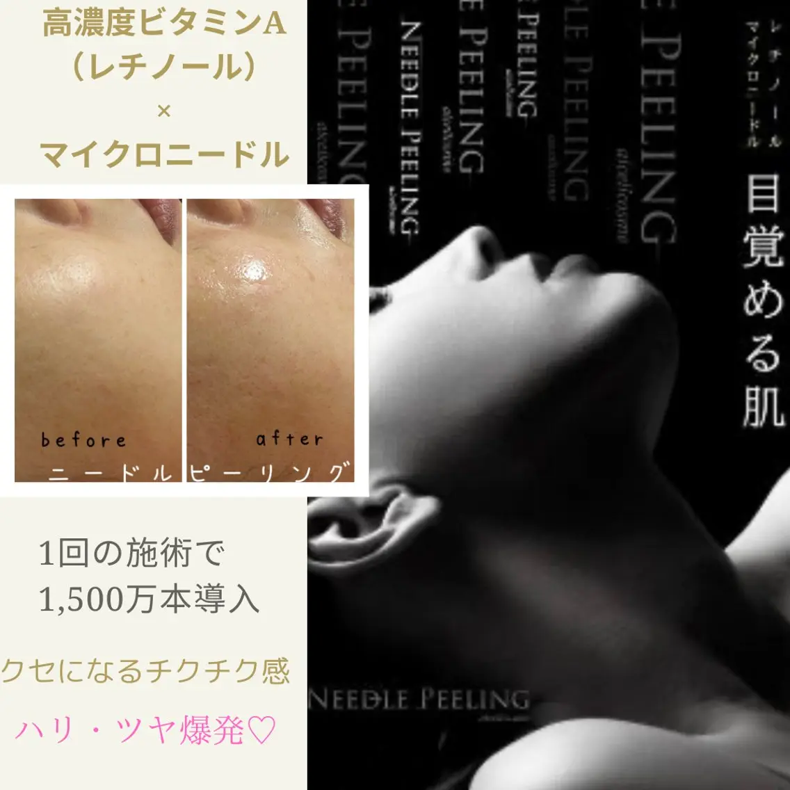 【毛穴】【毛穴開き】【小顔】【リフト】【くすみ】【吹き出物】マイクロニードル導入エステ🌟艶肌への写真