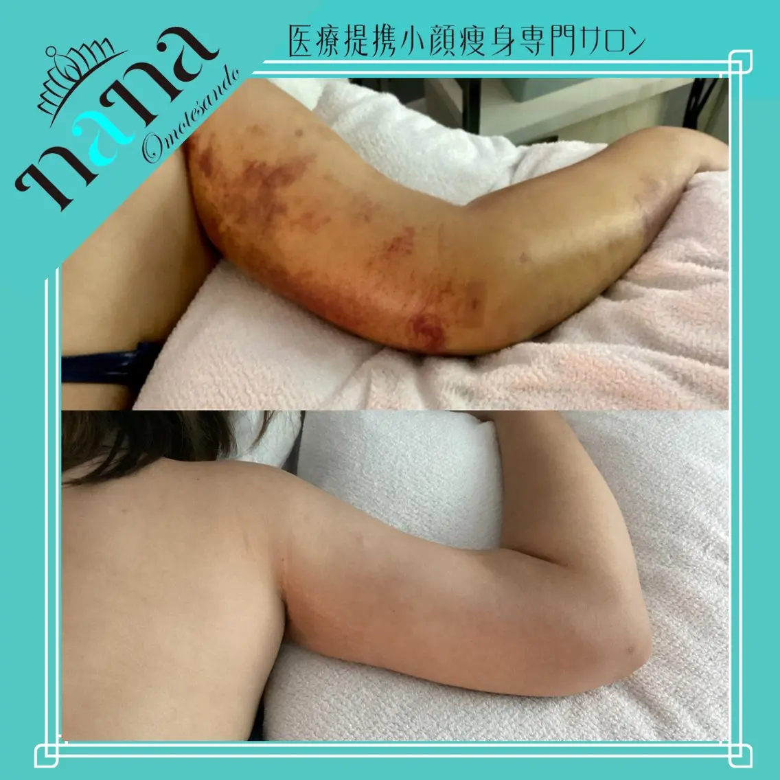 【美容施術前&後】ボディ1箇所(お顔とバスト以外)症状が軽め状態おすすめ/高周波温熱機器集中ケア◎60分コースの写真