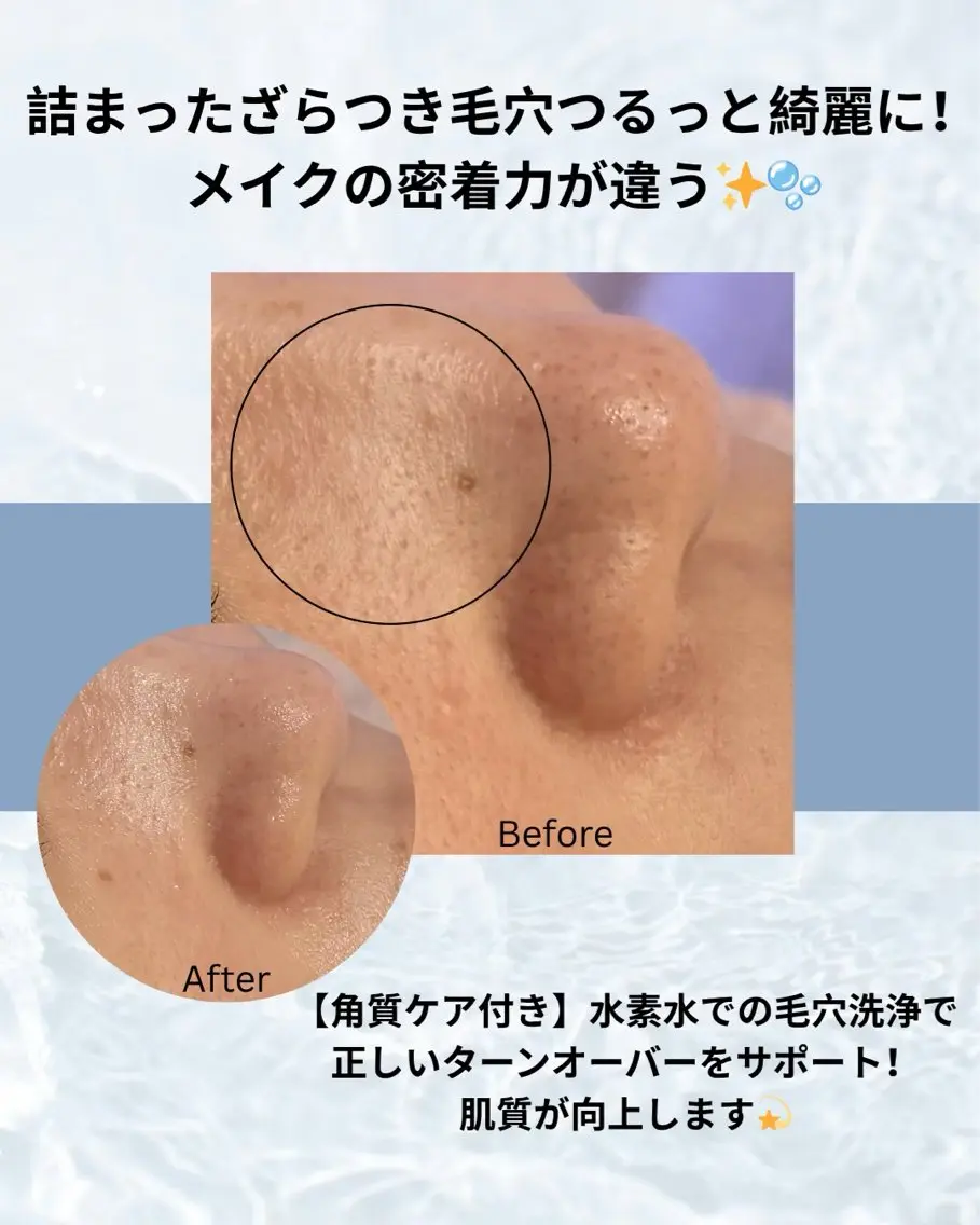 エステ 小顔&毛穴・肌質改善 LINDA西宮 AIのエステ・リラクイメージ