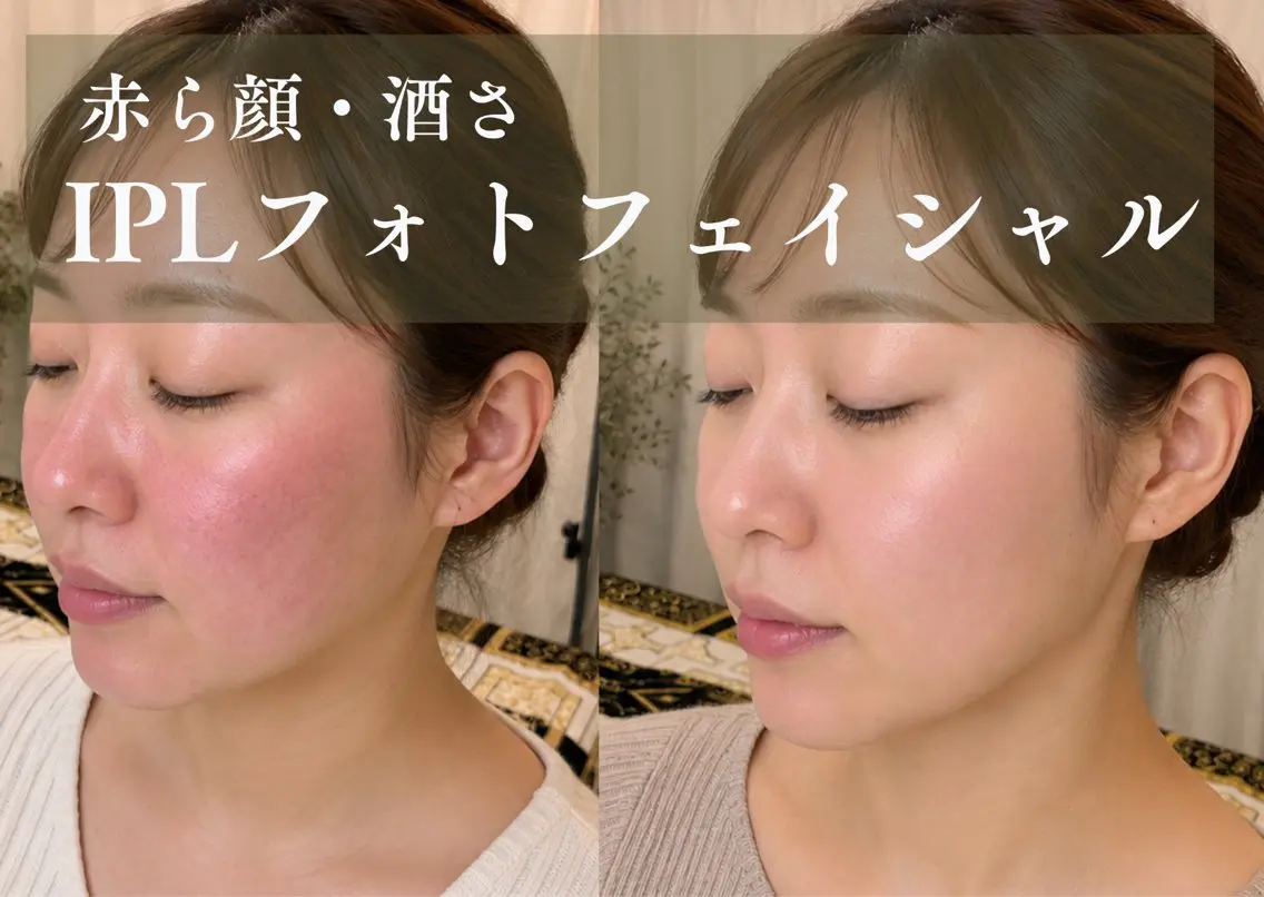 毛穴引締め、赤ら顔に光フェイシャル【通常9800円→5980円】の写真