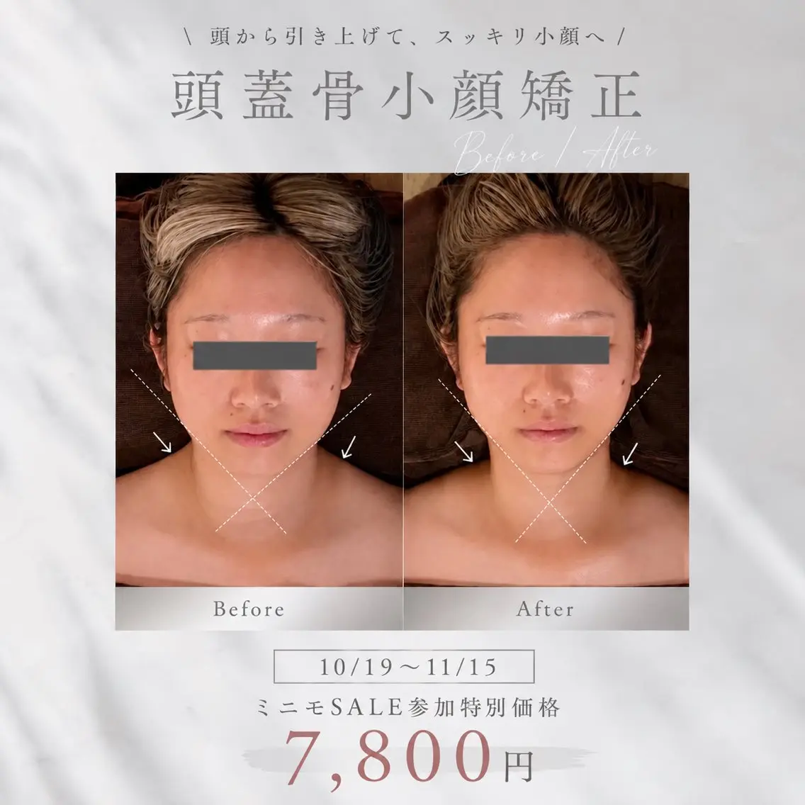 【10/19​〜​11/15⭐️ミニモSALE限定価格】頭蓋骨小顔矯正で小顔＋頭の重さ・顔の疲れもスッキリ軽く♪の写真