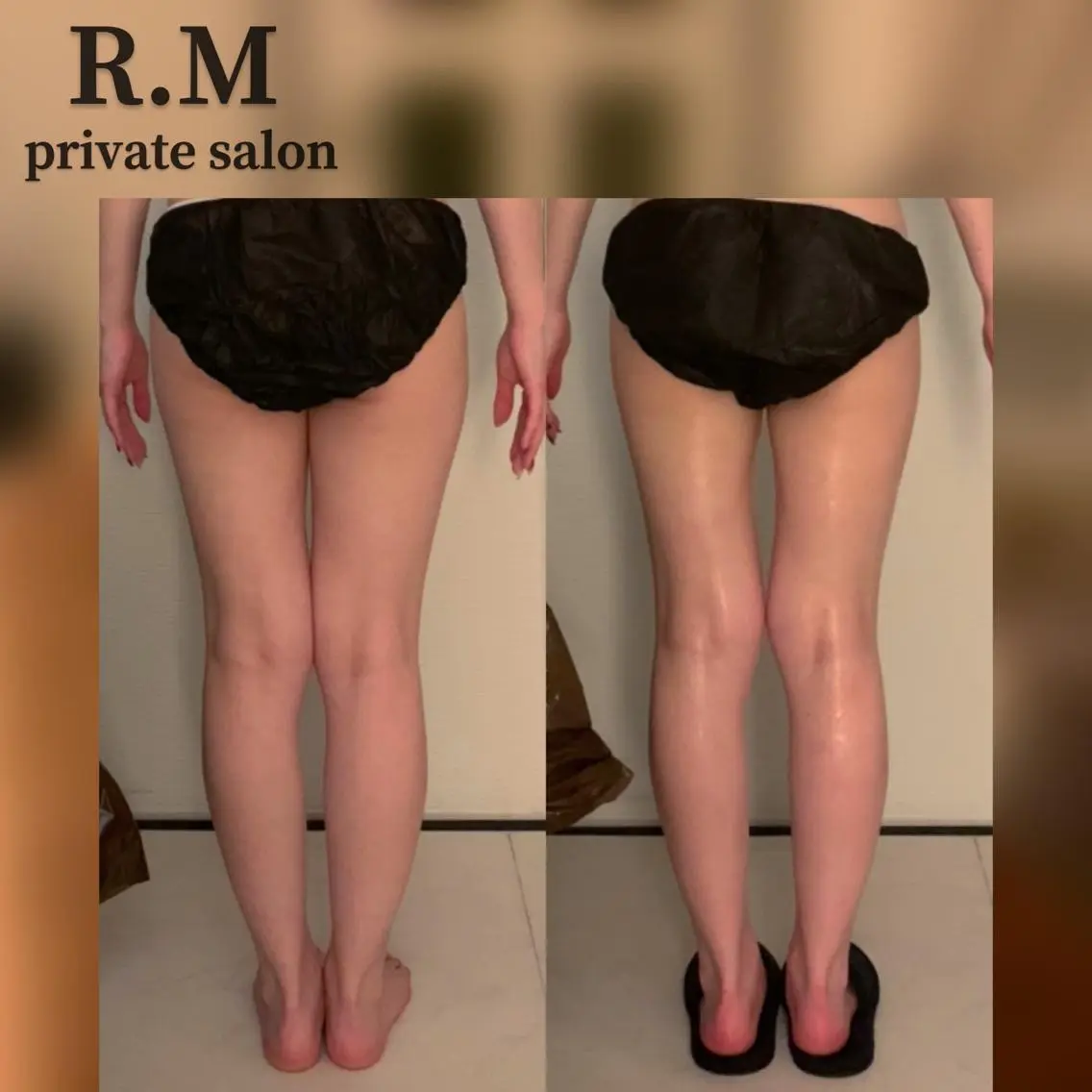 大人気セルライト剥がし❣️メンズ様も🙆の写真