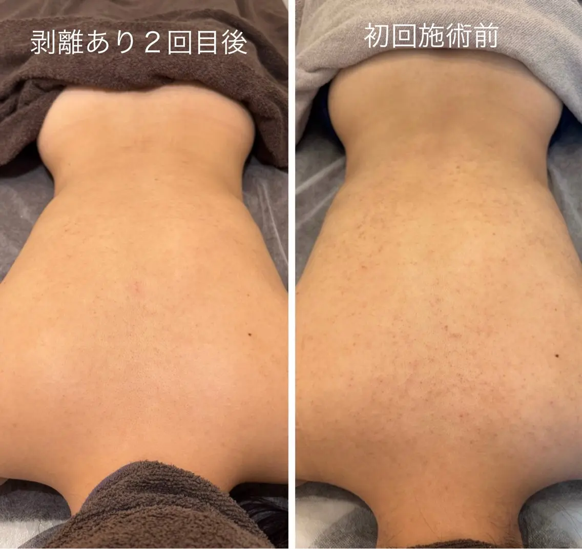 🌿ニキビ痕のお悩みに‼️剥離ありクリニカルハーブピーリング〈背中〉〈二の腕〉〈お尻〉〈顔〉選べる部位の写真
