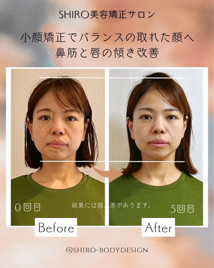 【40​〜​60代症例モニター】たるみ・フェイスライン改善🌿勝山式小顔美容矯正120分の写真