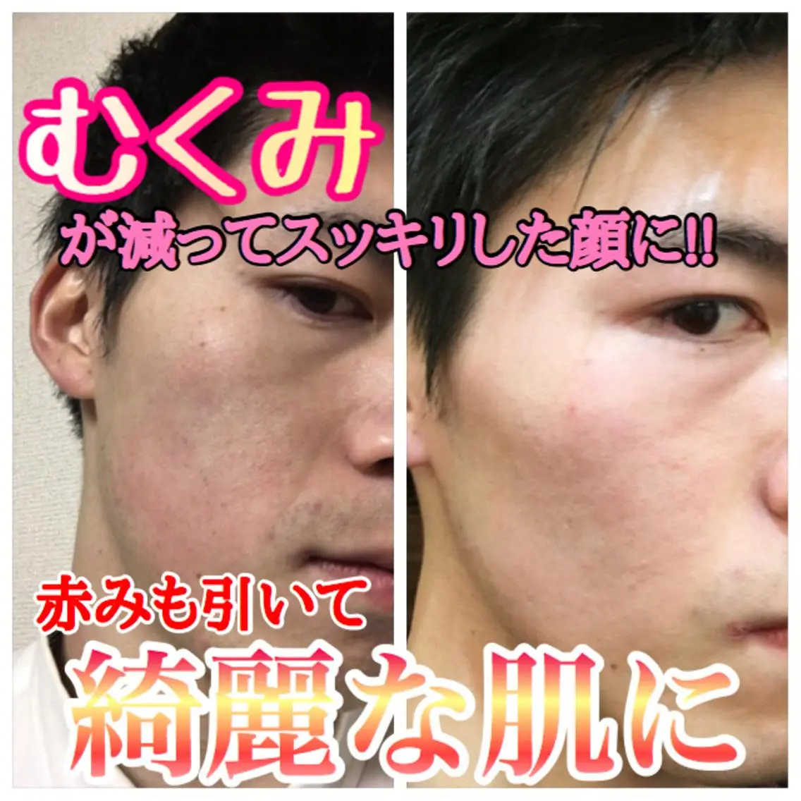 【新成人限定格安メニュー‼️】超お得❤️むくみスッキリ小顔スキンケア☺️の写真