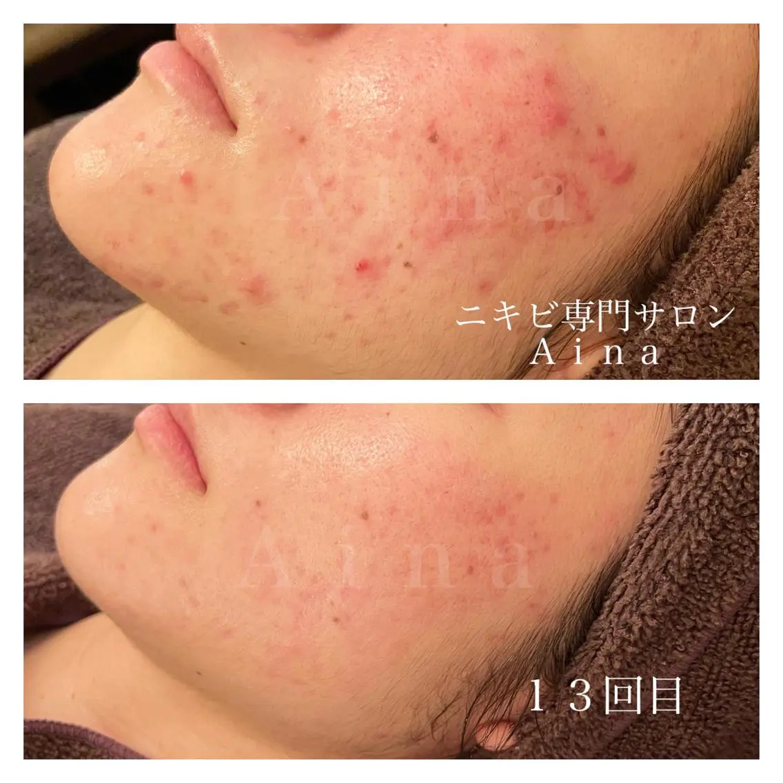ロング パーマ ヘアアレンジ メンズ キッズ ネイル マツエク・マツパ アイブロウ 赤色 ニキビ跡専門サロン Ainaのエステ・リラクイメージ