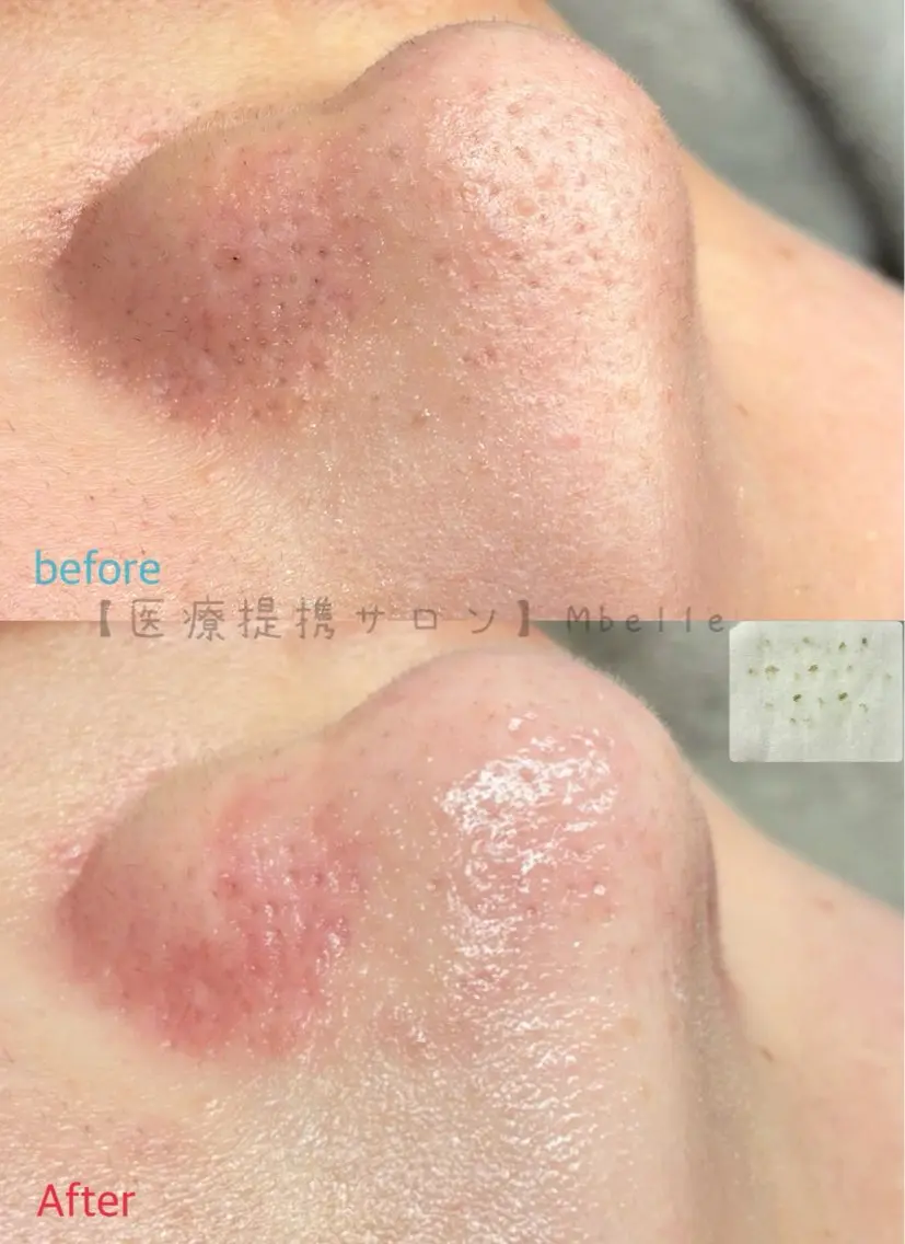 【閲覧注意レベル】毛穴エクストラクション(全顔)+美容液パック付きの写真