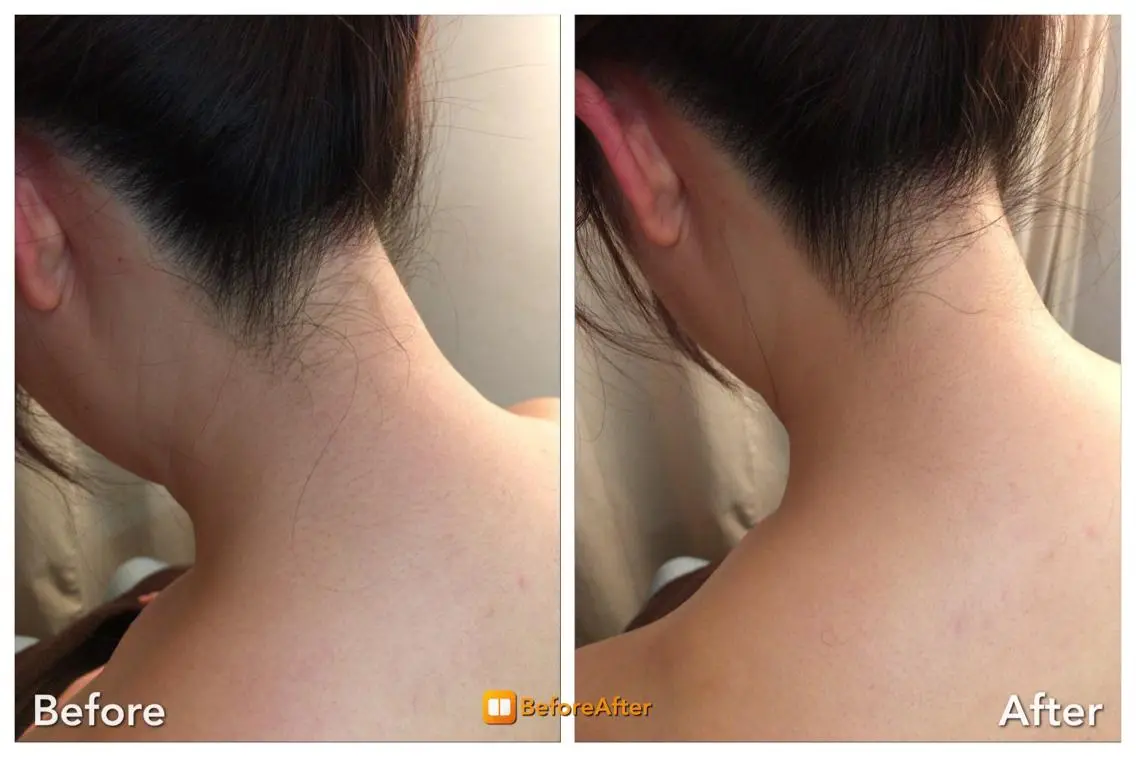 【脱毛】襟足の産毛、光脱毛で夏満喫♬（SHR、IPL、フラッシュ、光脱毛）の写真