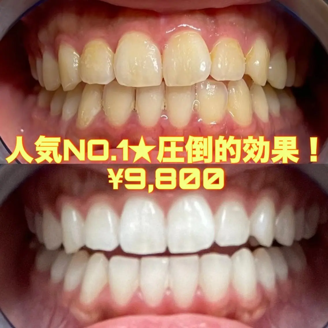 【1日2名様限定】🌈1番人気🌈【圧倒的効果!🔥】通常の6倍照射!セルフホワイトニング9,800円✨✨の写真