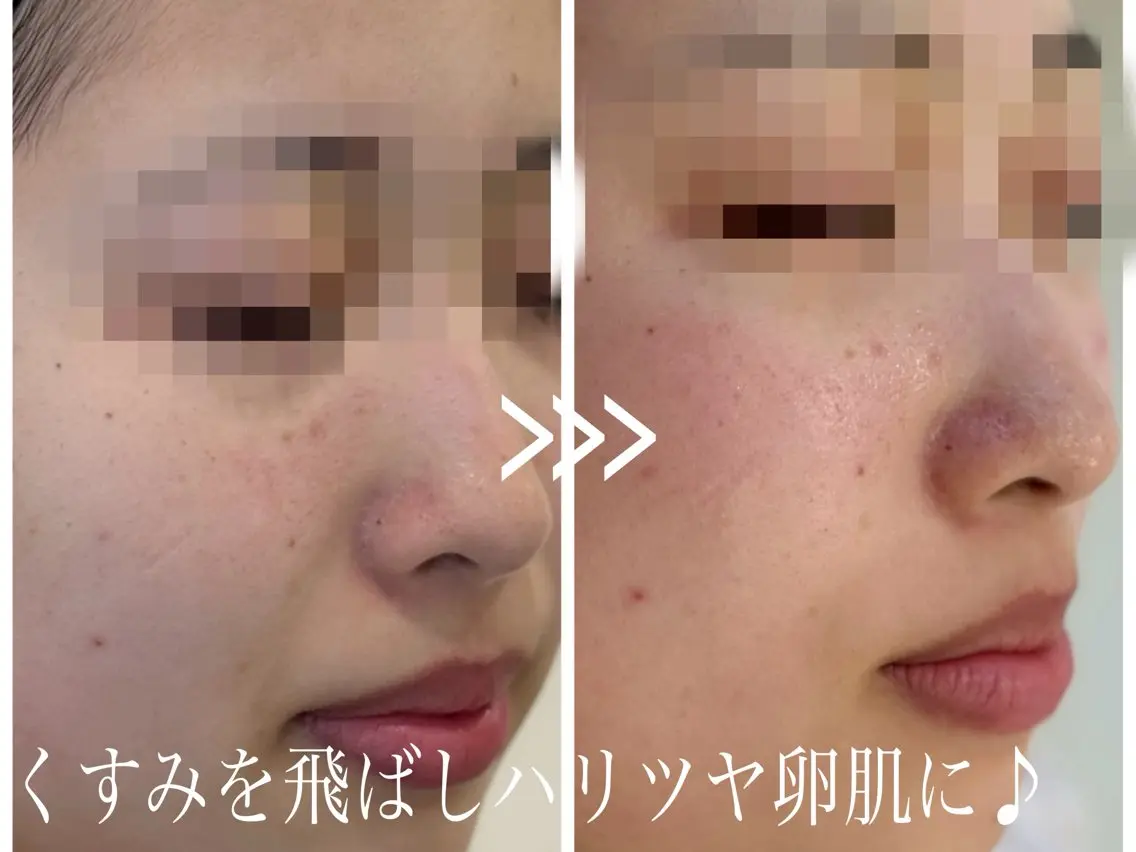 毛穴開き黒ずみ ニキビ特化💆♀️のエステ・リラクイメージ