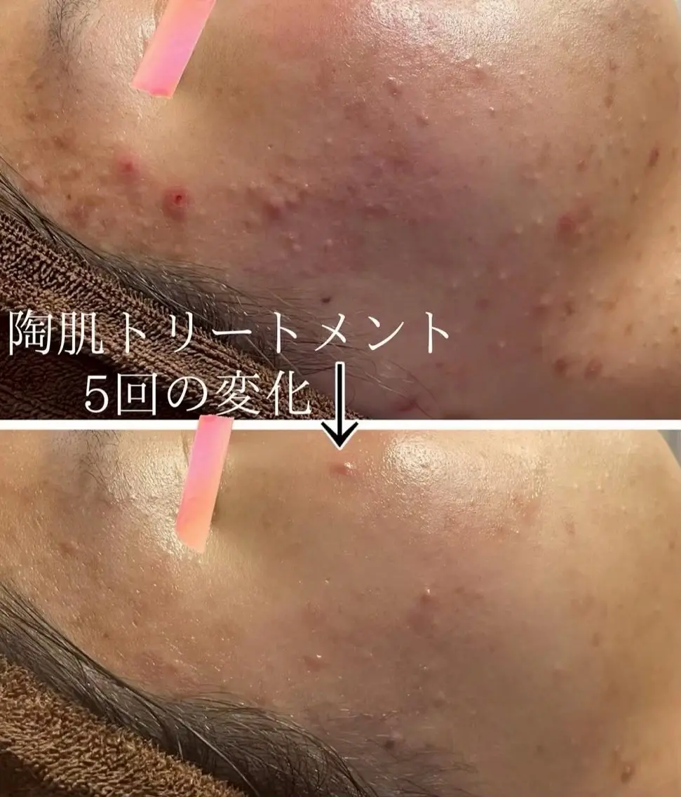 【頑固な毛穴・ニキビケア】REVI陶肌+高濃度ビタミンC(VCF)導入の写真