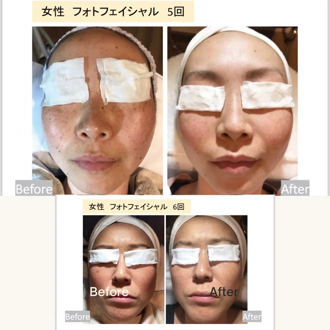 【モニター価格◎】シミ・シワ改善コース60分の写真