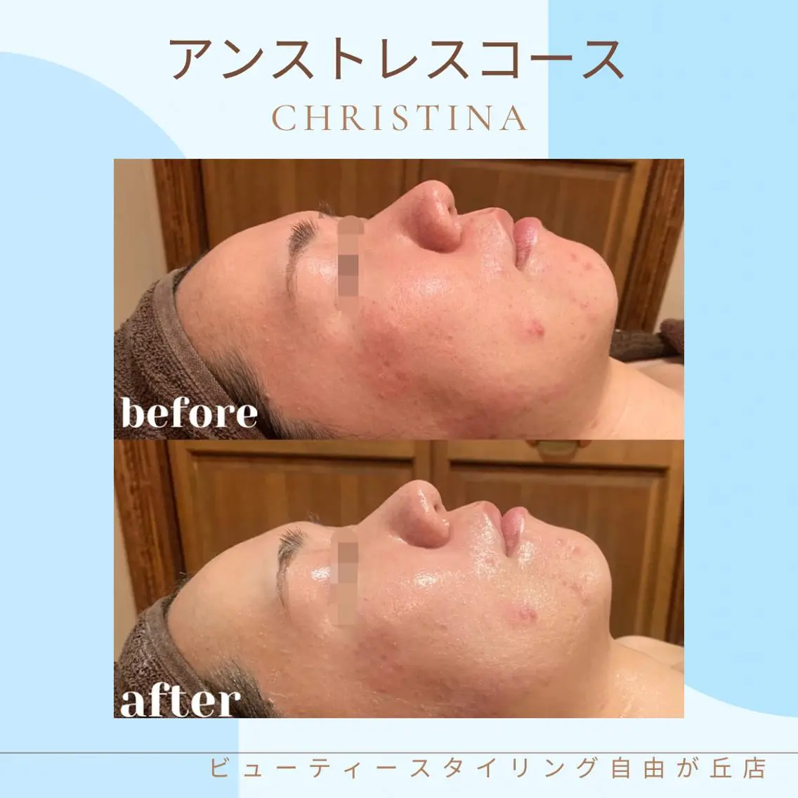 肌のストレス悩みに🛁【かゆみ・炎症・赤み・乾燥】当てはまったらこちらのコース✨の写真