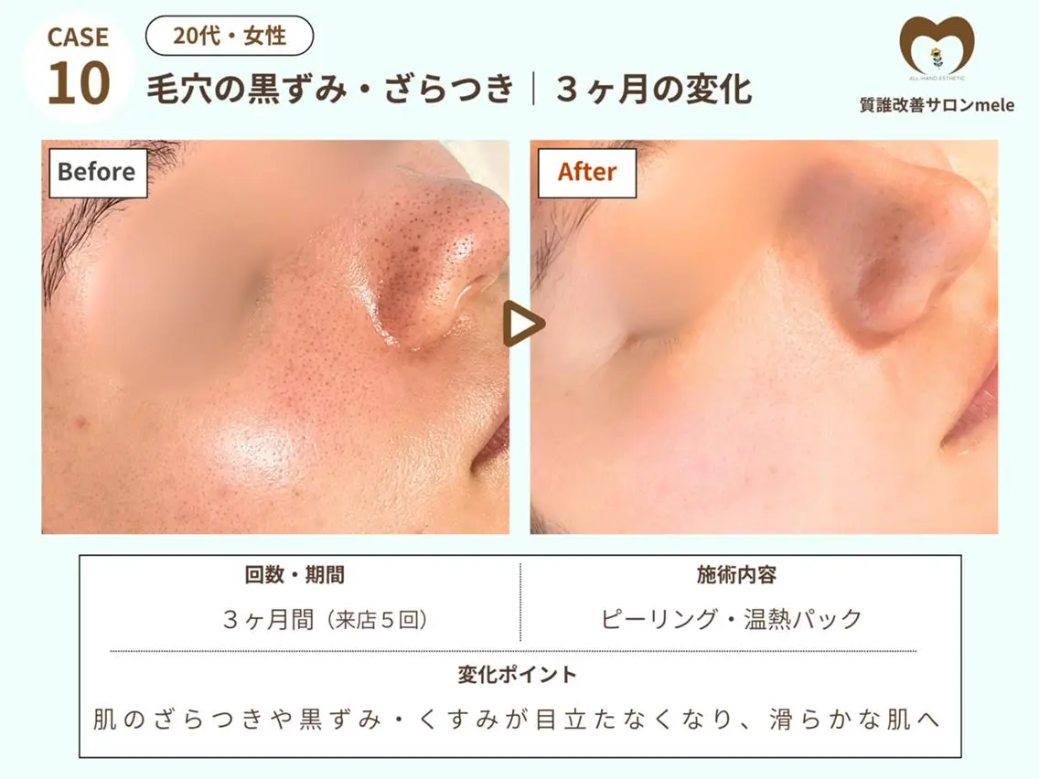 エステ リラク ニキビケア・毛穴専門 mele|もりぞののエステ・リラクイメージ