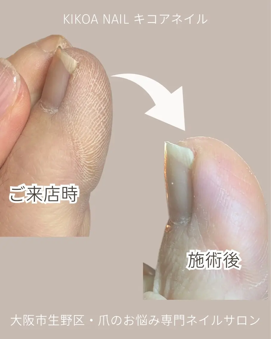 ネイル フットネイル フットネイル KIKOA NAIL キコアネイルのネイルデザイン