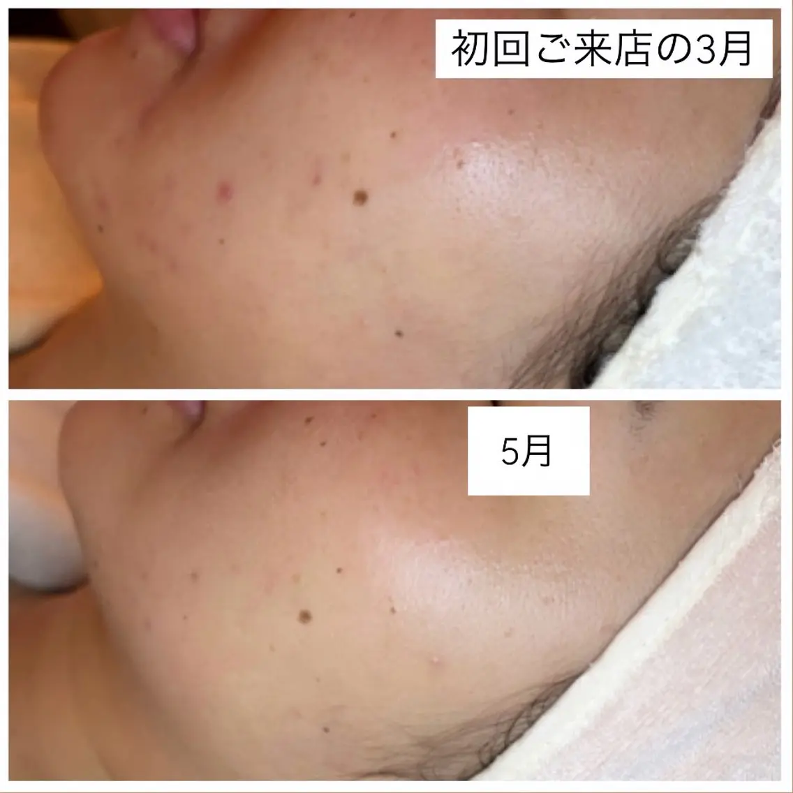 ピーリングでお肌を整えることからスタート💆♀️むくみ撃退、つや肌美容液導入🫧/80分コースの写真
