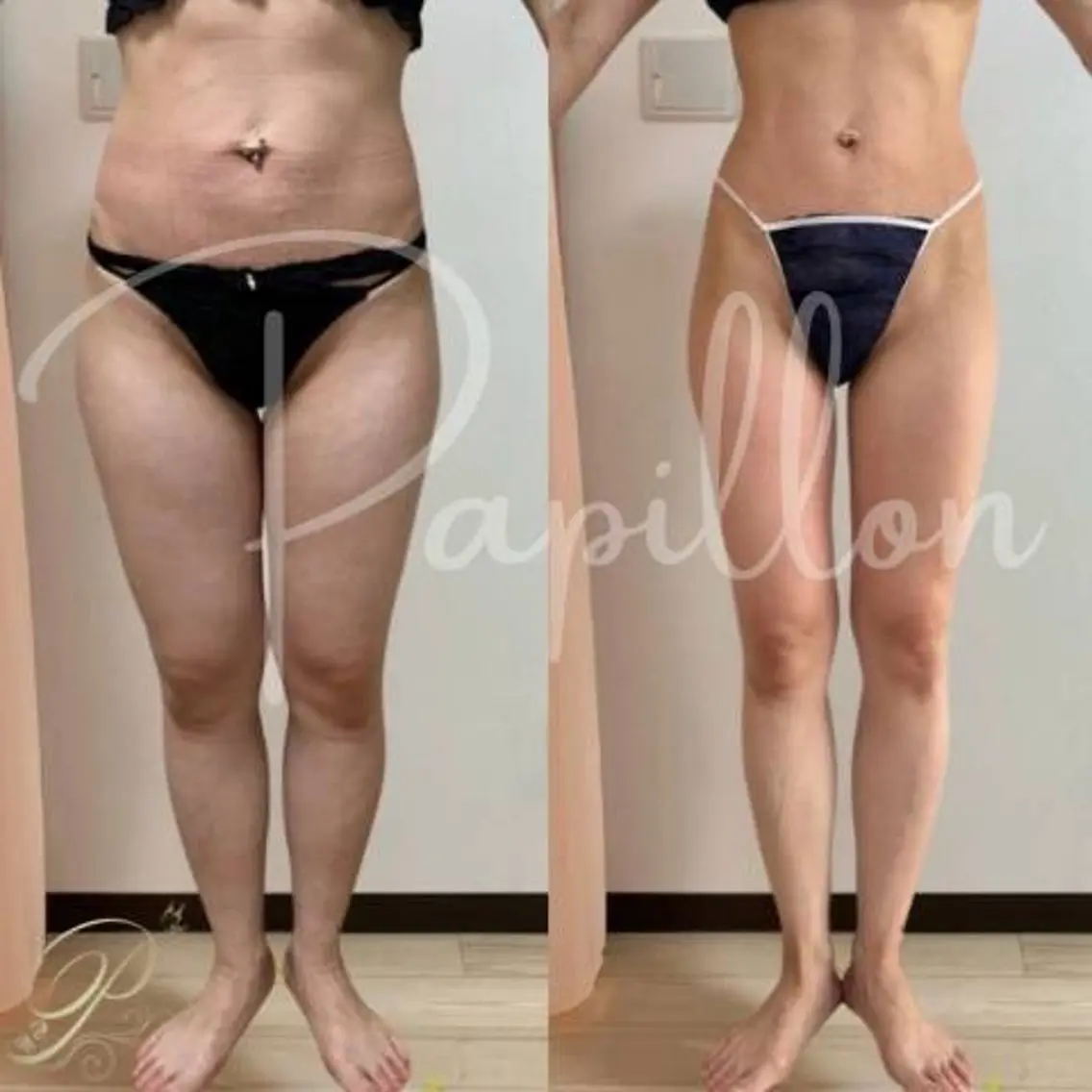 何しても痩せない方へ🔥全身集中ダイエット ¥9,900の写真
