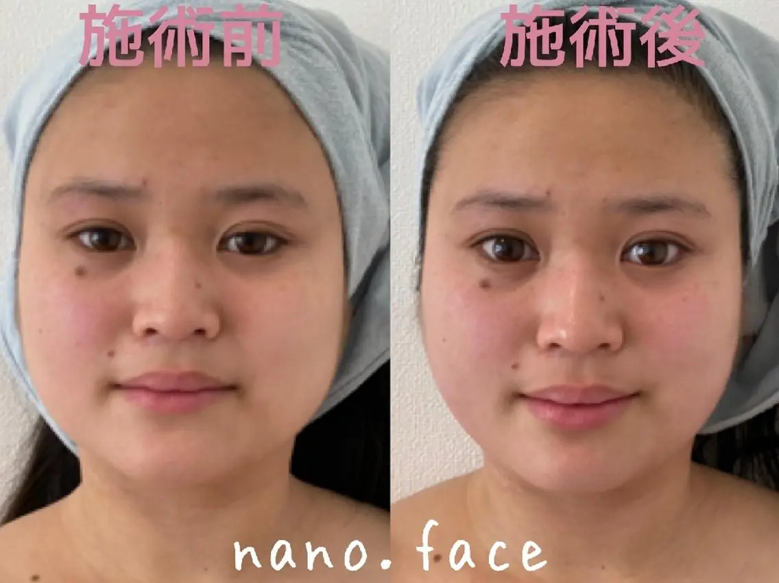 マツエク・マツパ 美容鍼/小顔&整体 nano.faceのエステ・リラクイメージ