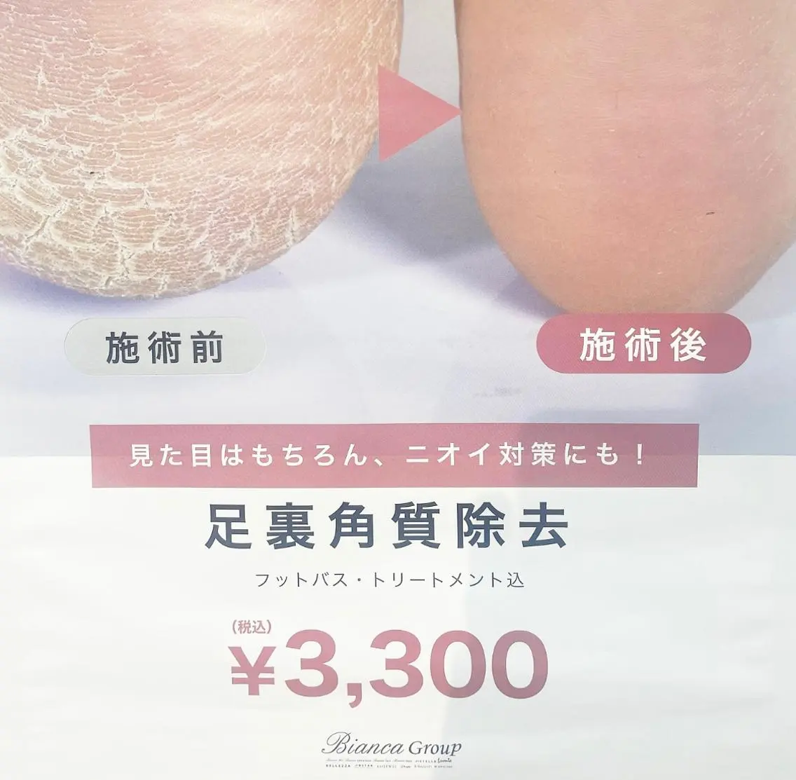 🫧フット足裏角質ケア🫧の写真