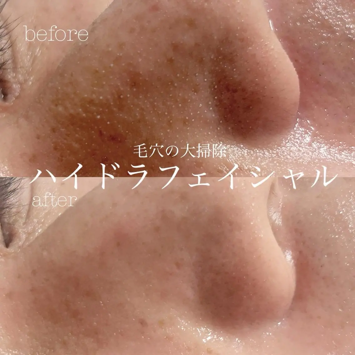 【💗期間限定💗】ハイドラフェイシャルフルコース✨美容液導入➕毛穴引き締め➕コラーゲンパック付きの贅沢コース毛穴洗浄の写真