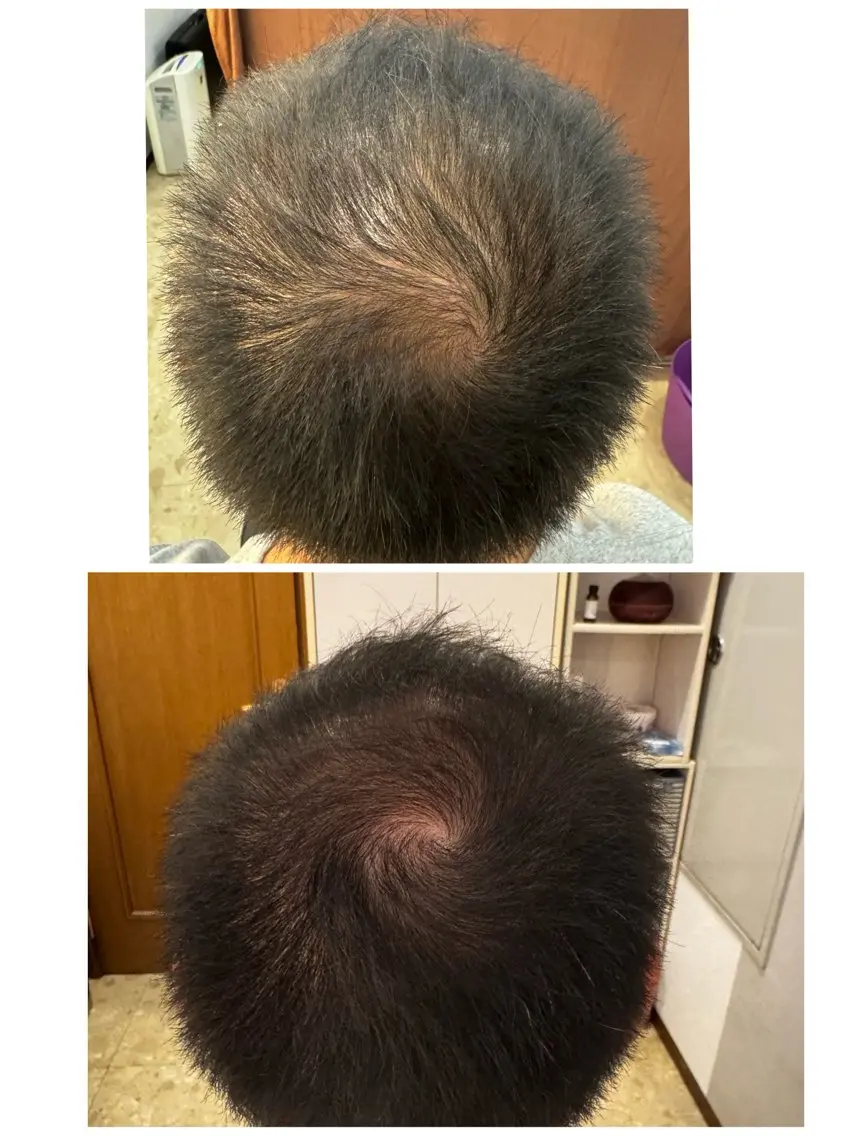 【薄毛改善施術】¥3300→¥3000の写真