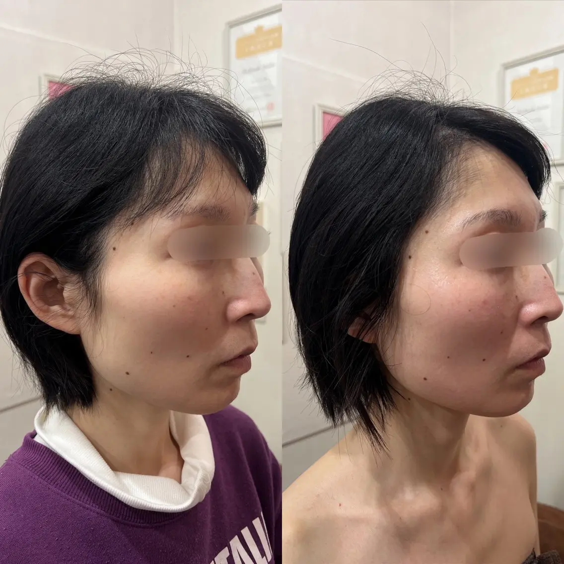 毛穴改善/脱毛 ネイル　川上久仁子のエステ・リラクイメージ