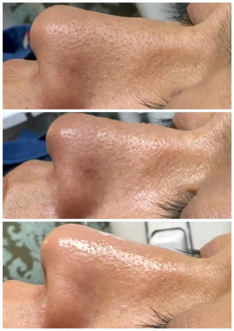 【メンズ限定】毛穴ディープクレンジング💆毛穴汚れもテカリもスッキリ🌟頑固な汚れを根こそぎオフ✨の写真