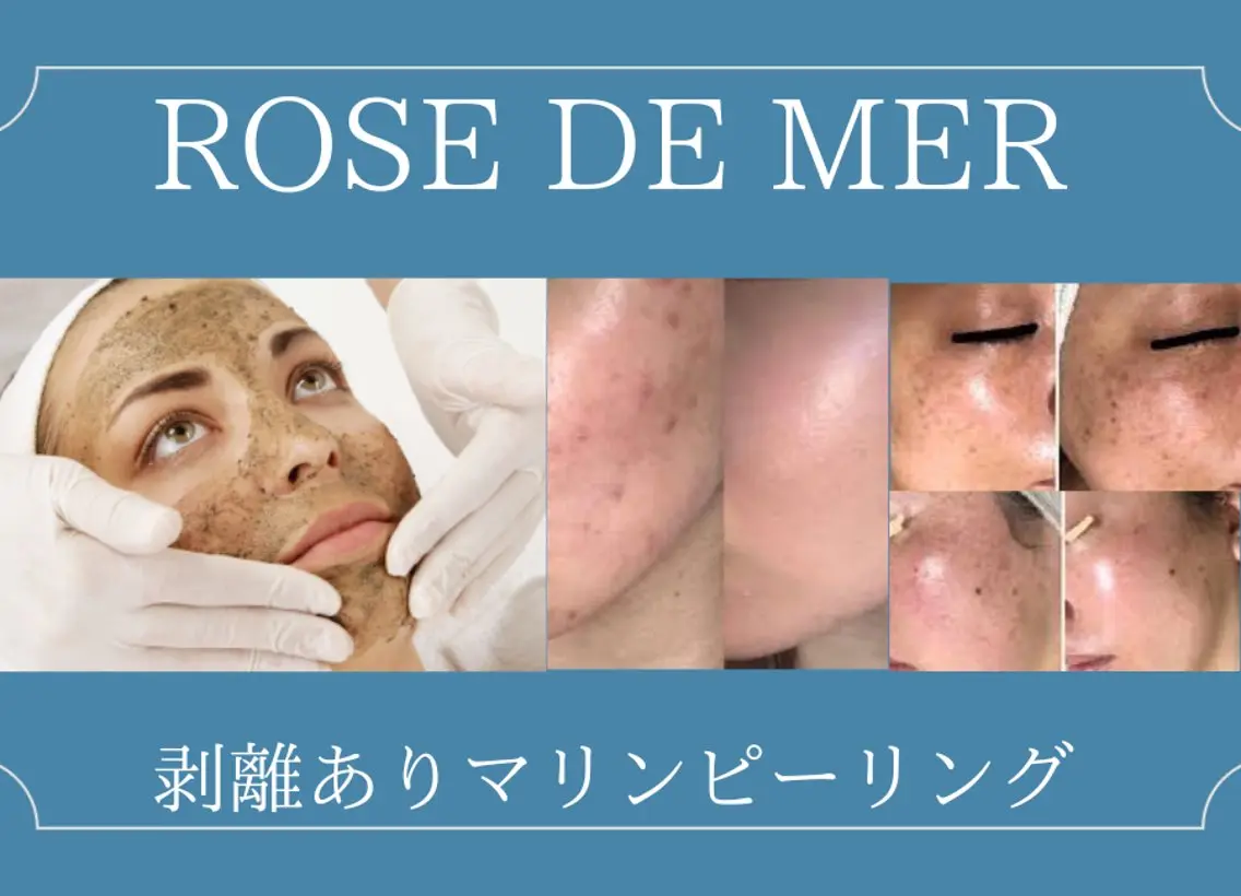 🌿剥離ありハーブピーリング🌿芸能人御用達のローズドメーラ💎繰り返す肌荒れ/ニキビ跡/クレーター/毛穴に◎の写真