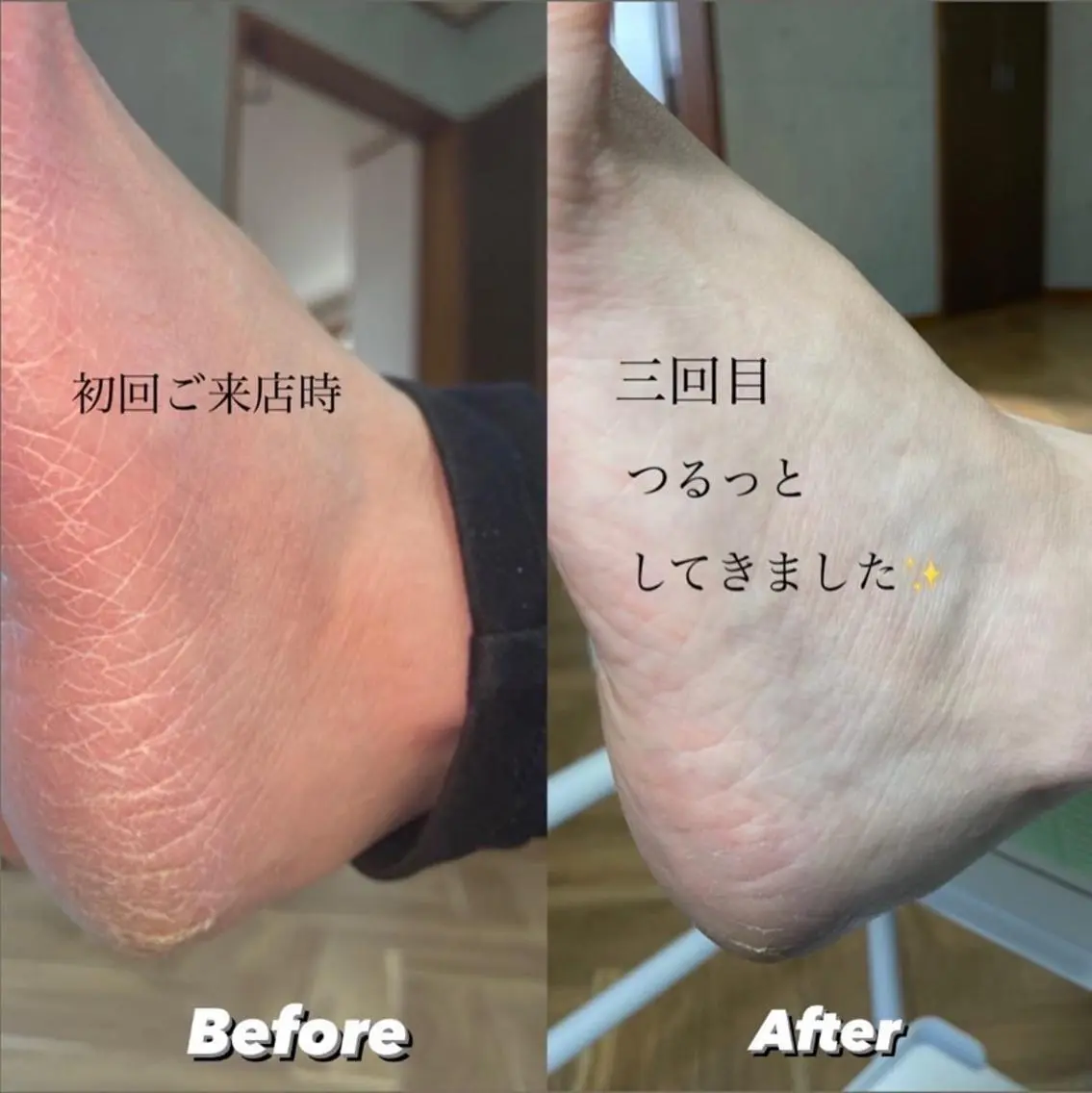 極上foot care👣✨【足裏角質除去】の写真