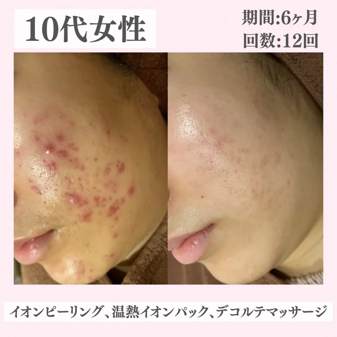 エステ リラク ニキビ・肌質改善専門 ♡人生が変わるサロンのエステ・リラクイメージ