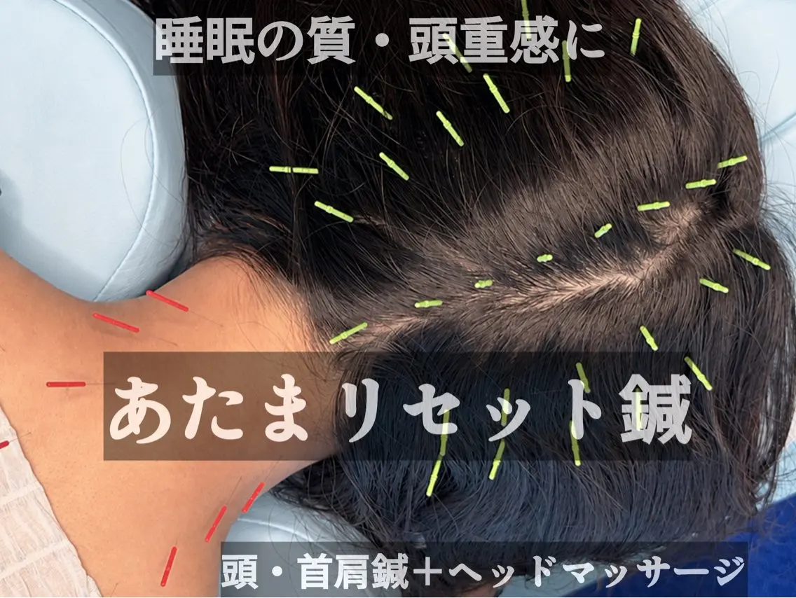【睡眠の質・頭重感に】あたまリセット鍼｜頭・首肩鍼×ヘッドマッサージ 50分の写真