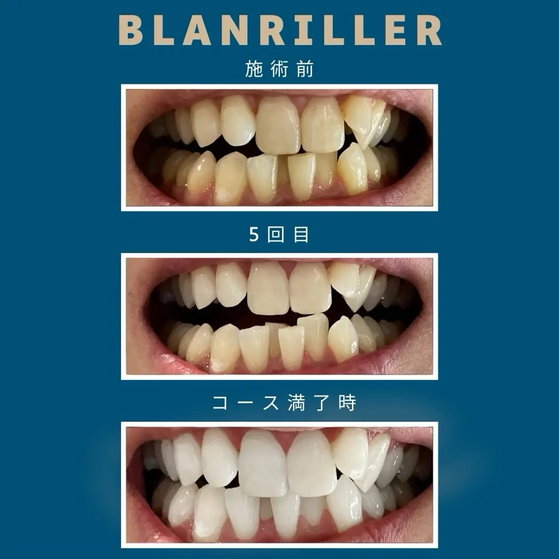 【3ヶ月通い放題】丁度良いで大人気✨高濃度セルフホワイトニング月額10800円❤安心・安全のどこよりも高品質で低価格🎶の写真